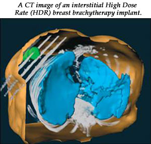 A CT image of an interstitial High Dose Rate (HDR) breast brachytherapy implant.
