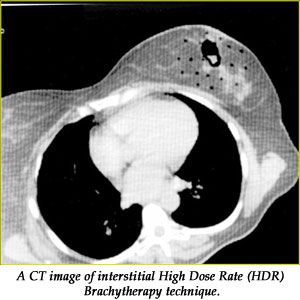 A CT image of interstitial High Dose Rate (HDR) Brachytherapy technique.