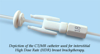 Depiction of the CT/MR catheter used for interstitial High Dose Rate (HDR) breast brachytherapy