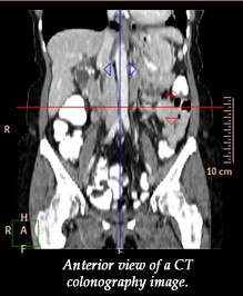 Anterior view of a CT colonography image.