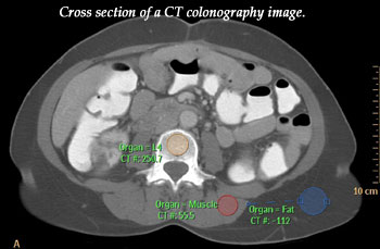 Cross section of a CT colonography image.