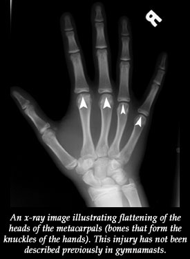 An MRI image illustrating flattening of the heads of the metacarpals (bones that form the knuckles of the hands). This injury has not been described previously in gymnasts.